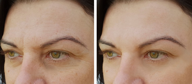facial before and after